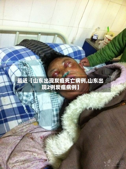 最近【山东出现炭疽死亡病例,山东出现2例炭疽病例】-第1张图片