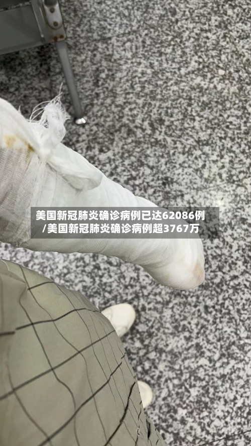 美国新冠肺炎确诊病例已达62086例/美国新冠肺炎确诊病例超3767万-第1张图片