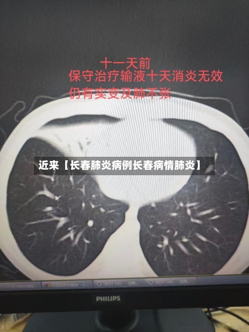 近来【长春肺炎病例长春病情肺炎】-第3张图片