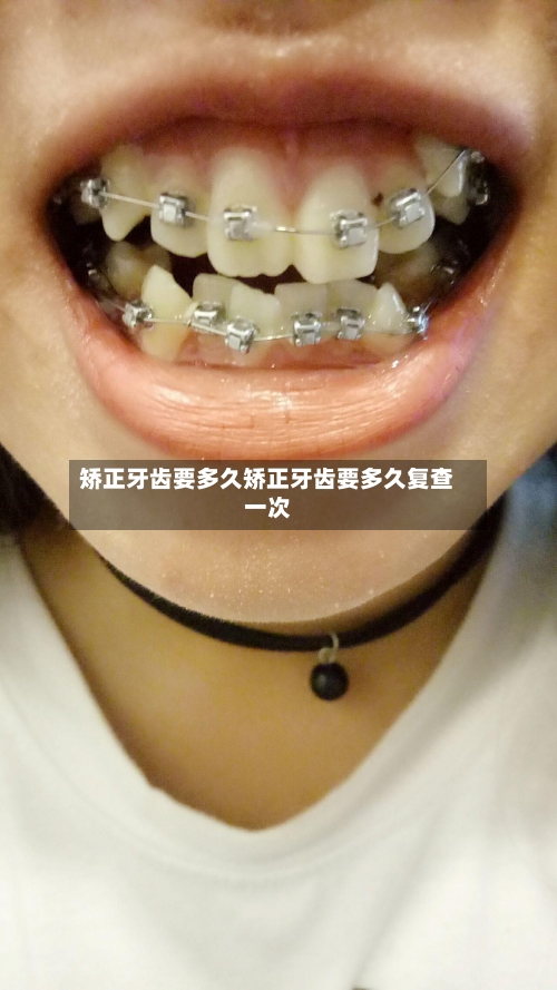 矫正牙齿要多久矫正牙齿要多久复查一次