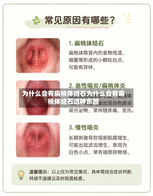 为什么会有扁桃体结石为什么会有扁桃体结石这种东西