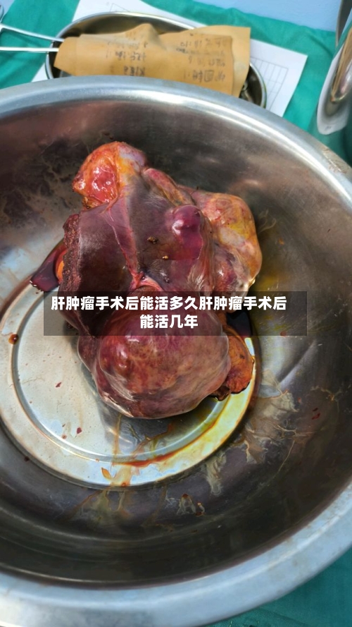 肝肿瘤手术后能活多久肝肿瘤手术后能活几年